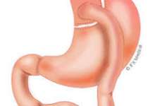 بیمارستان |چاقی