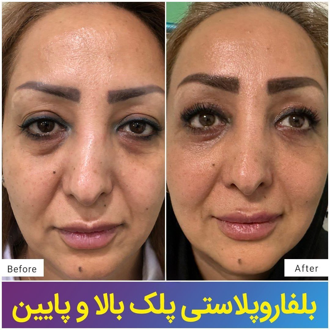 جراحی پلک یا بلفاروپلاستی چیست؟